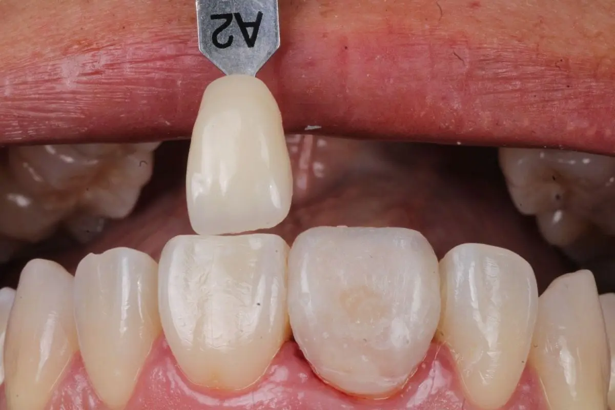 Carilla estética: después del tratamiento