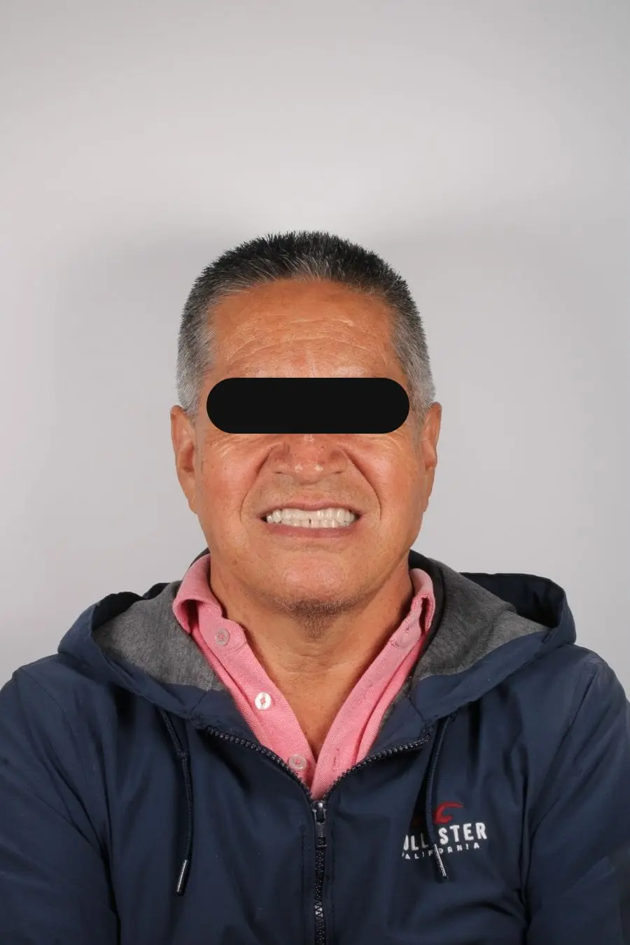 Prótesis parcial removible: después del tratamiento